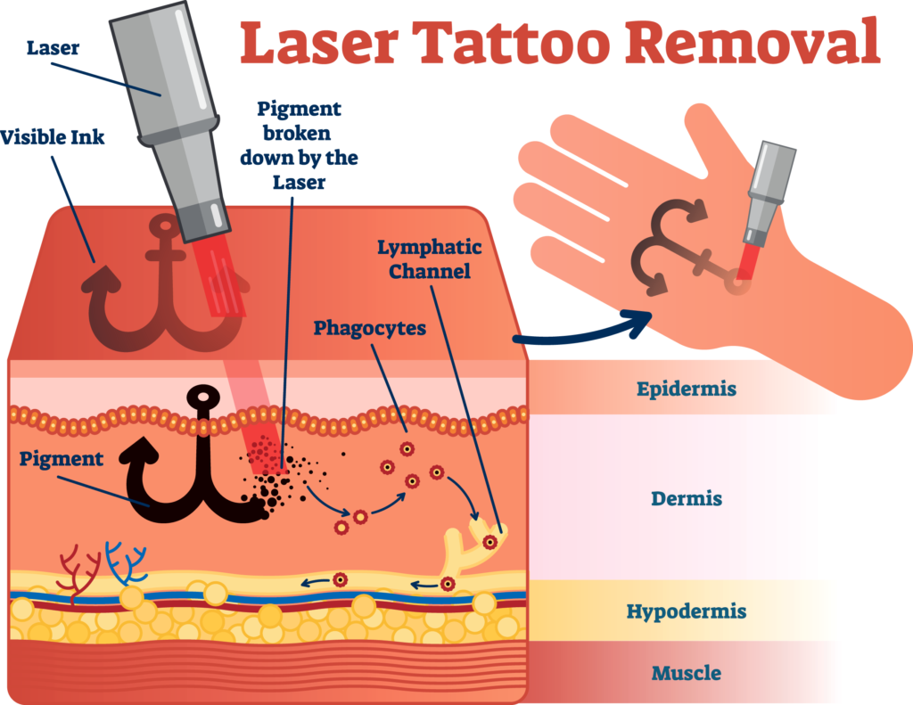 fjerning av tatovering med laser